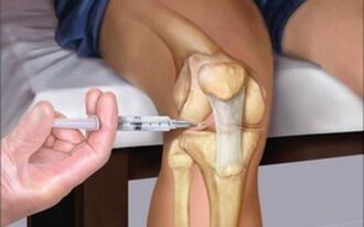 intra-articular injection into the joint for osteoarthritis