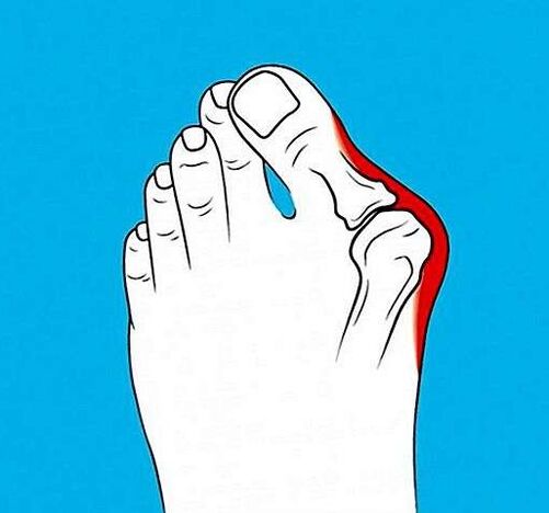 osteoarthritis of the toe joint