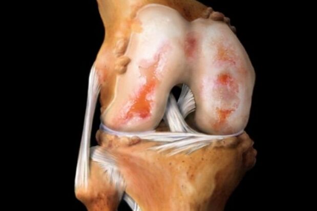 Cartilage damage in osteoarthritis of the knee. 