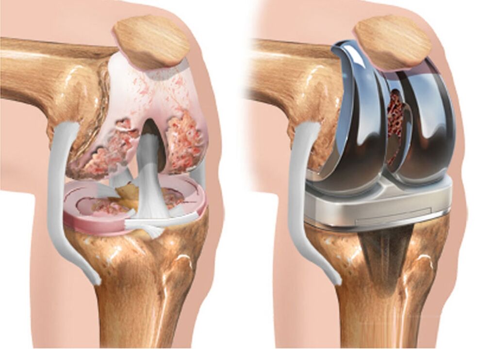 before and after osteoarthritis of the knee joint due to osteoarthritis