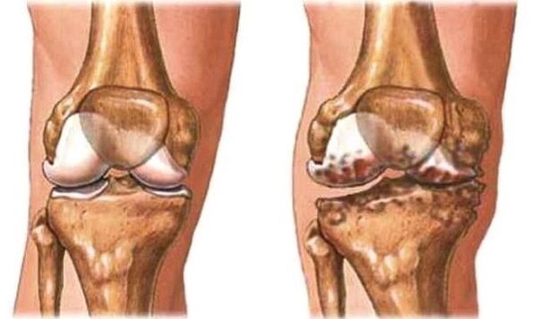 knee osteoarthritis and healthy knee