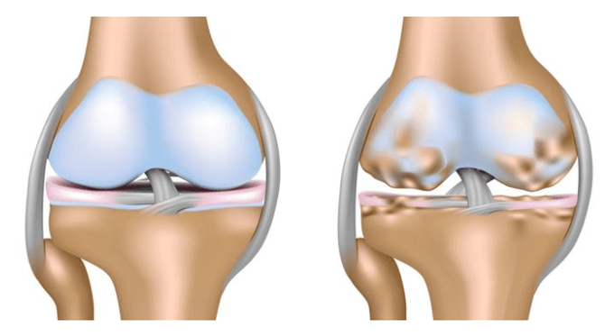 healthy cartilage and damage to the knee joint with osteoarthritis