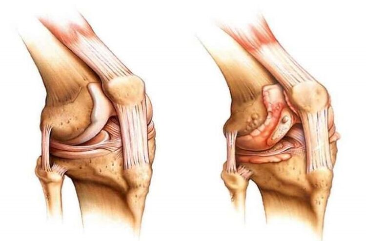 healthy knee and osteoarthritis of the knee joint