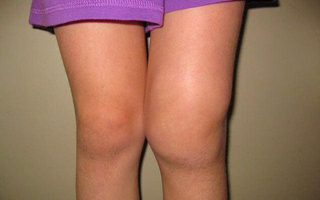 swollen knee joint due to osteoarthritis