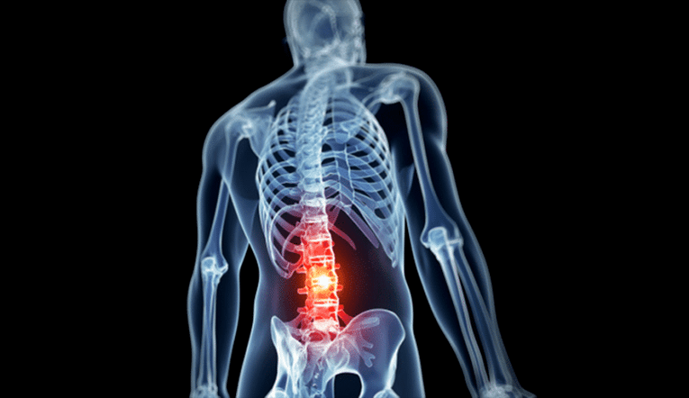 lumbar spine injury in osteochondrosis