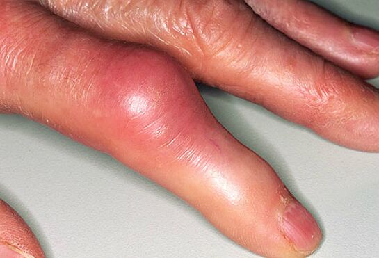 Gout is accompanied by acute pain in the fingers and swelling of the joints. 