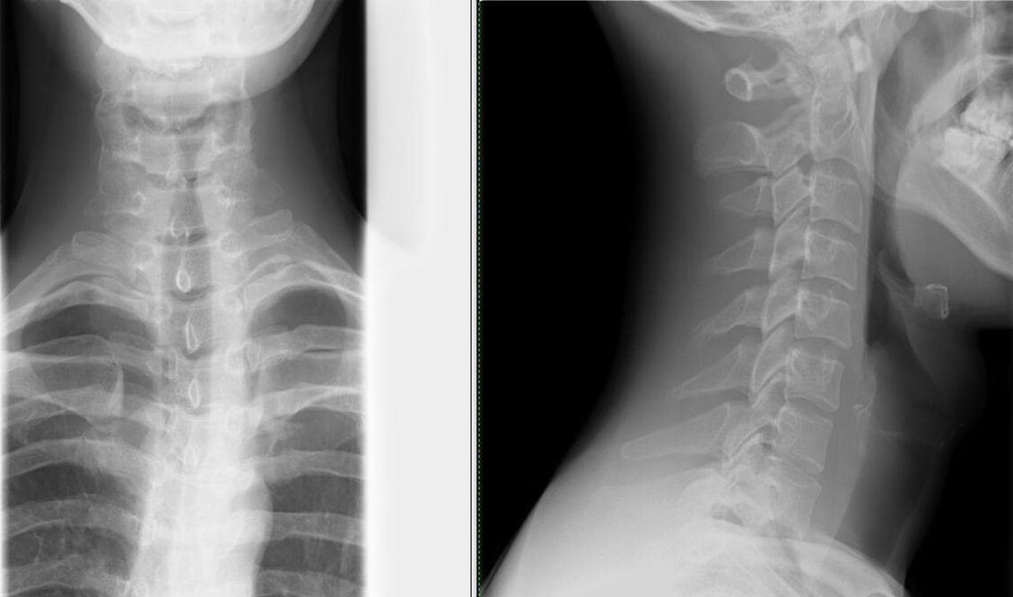 Spinal x-ray is a simple and effective method to diagnose osteochondrosis