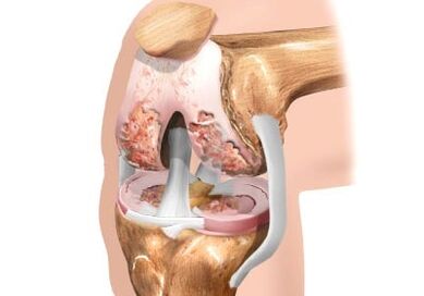 Damage to the knee joint joint