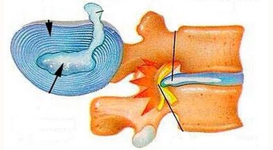 Characteristics of the development of cervical osteochondrosis