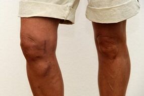Swelling of the knee joint due to osteoarthritis.