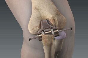 osteoarthritis knee replacement