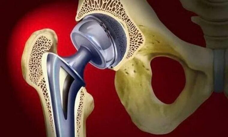 endoprostheses