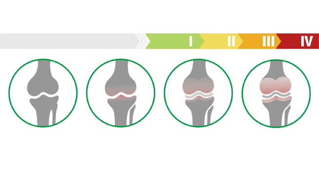 stages of athrosis